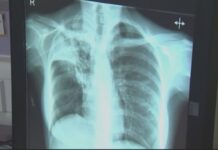 Kansas officials say risk is low after tuberculosis outbreak