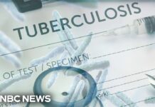 Tuberculosis outbreak reported in Kansas